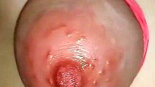 Huge, Breast Tear