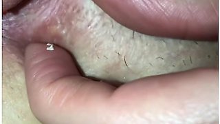 Doctor Pimple Popr Pussy Edition: Tag Teamed Her Ingrown Hair Cyst & Something Else